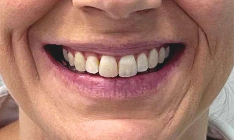 Invisalign-Before-and-After-After-Image