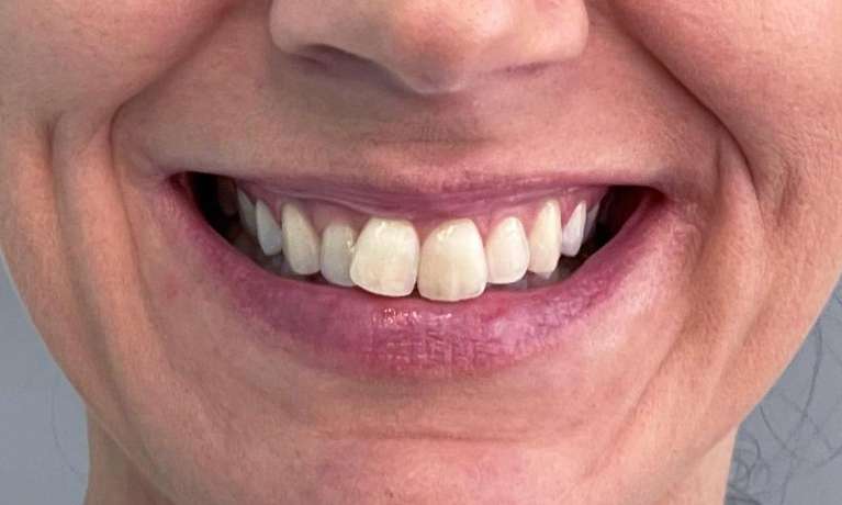 Invisalign-Before-and-After-Before-Image